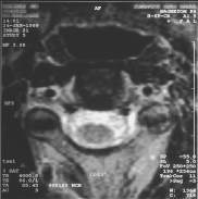 MRI scan 21 (SP = -55.0), Nek