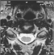 MRI scan 22 (SP = -31.6), Nek