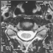 MRI scan 23 (SP = -9.5), Nek