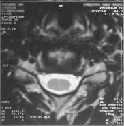 MRI scan 24 (SP = 10.4), Nek
