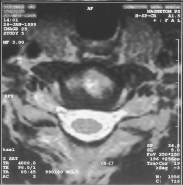 MRI scan 25 (SP = 34.8), Nek